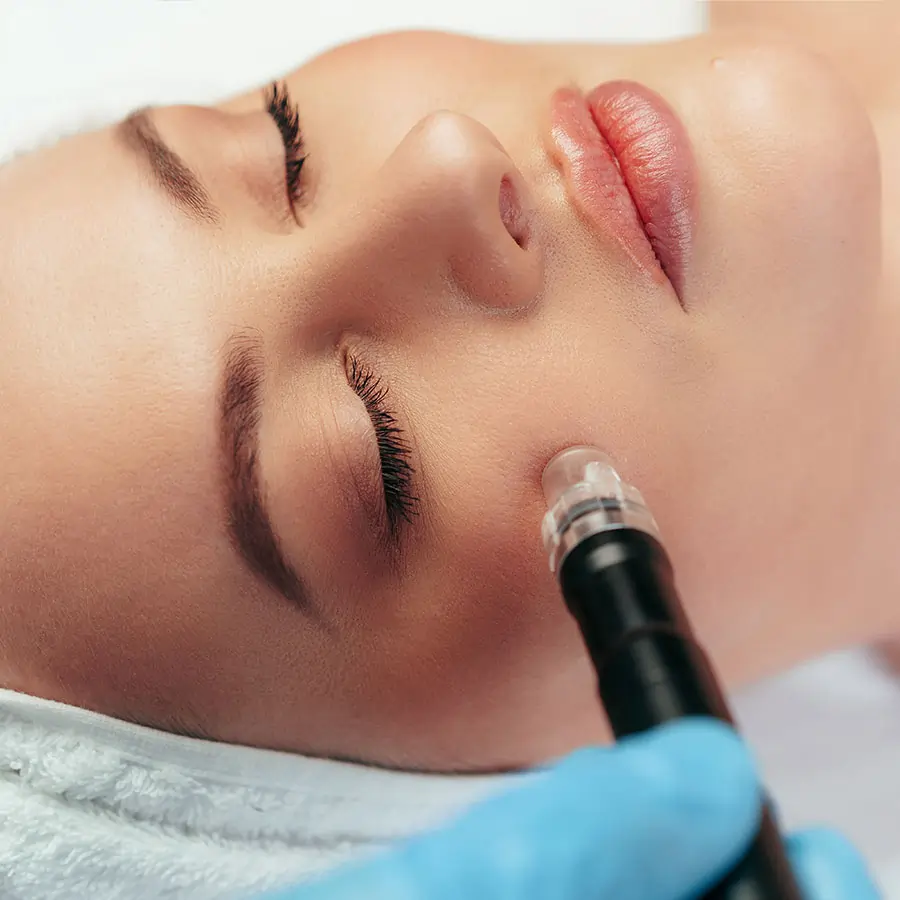 microneedling mikroneedling behandlung kosmetik facial gesichtsbehandlung in Saarbruecken Saarland Bianca Ion BB Beauty Balance Kosmetikstudio